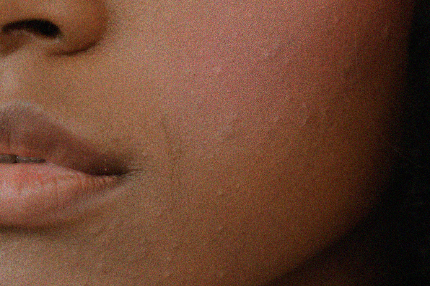 How to Treat Acne in 2022 | How to get Glowing Acne-free Skin Part 1