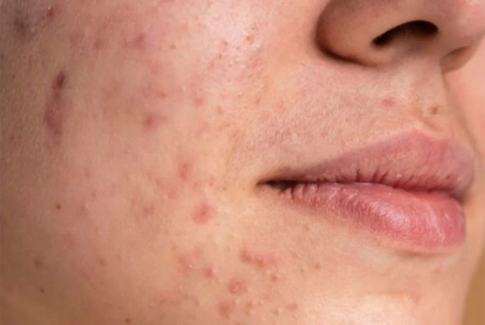 Skin Purging: What It Is & How to Manage It Successfully