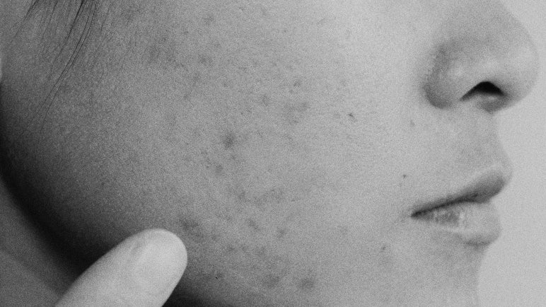 How to Treat Acne Hyperpigmentation