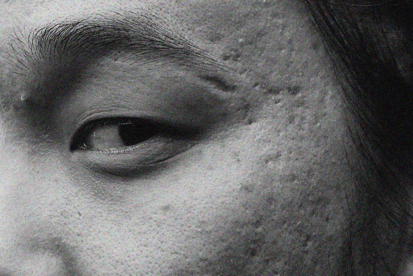 4 Decisive Actions You Can Take Today To Prevent Acne Scarring