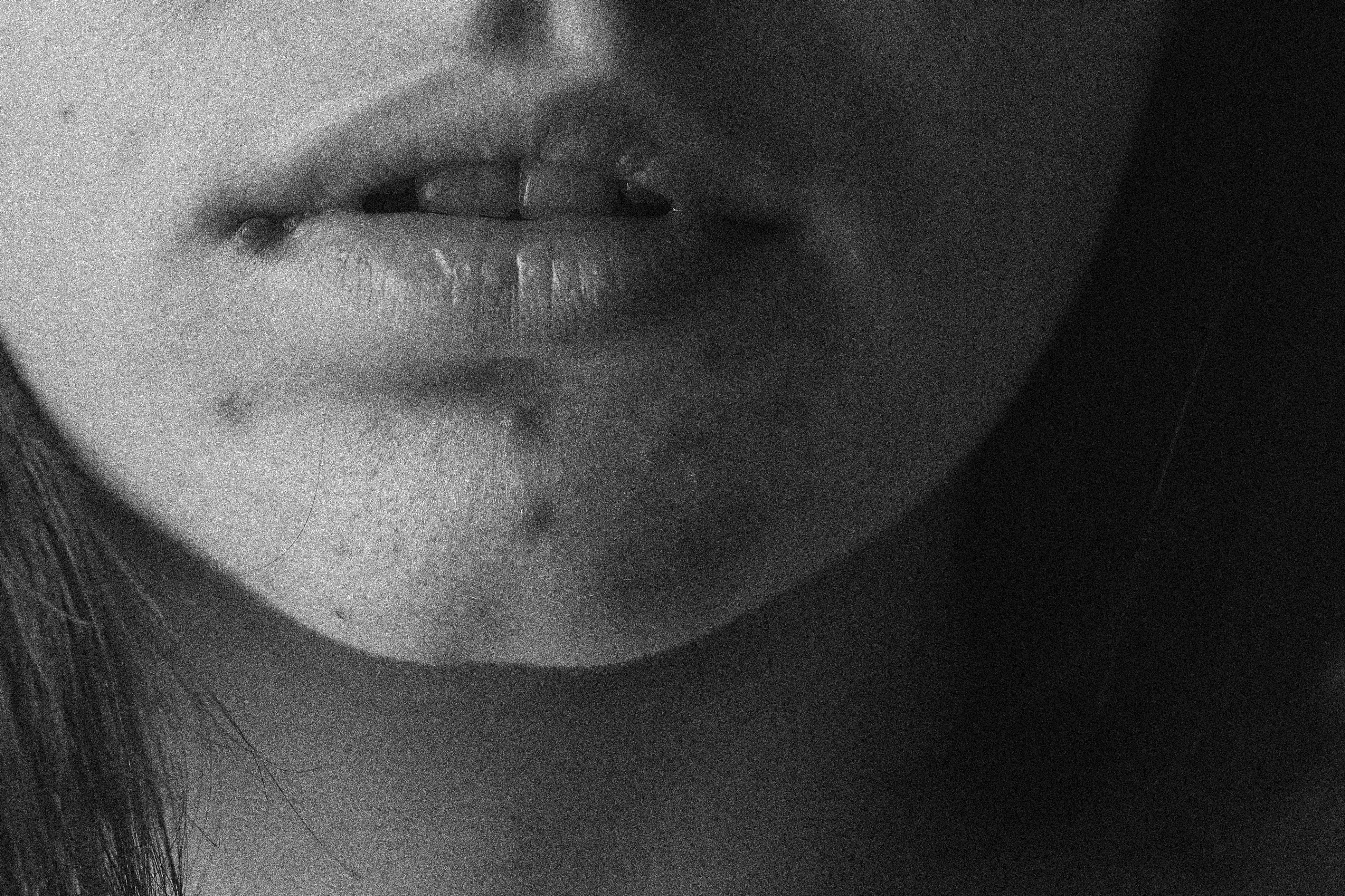 Answering Google’s Most Frequently Asked Questions on Acne