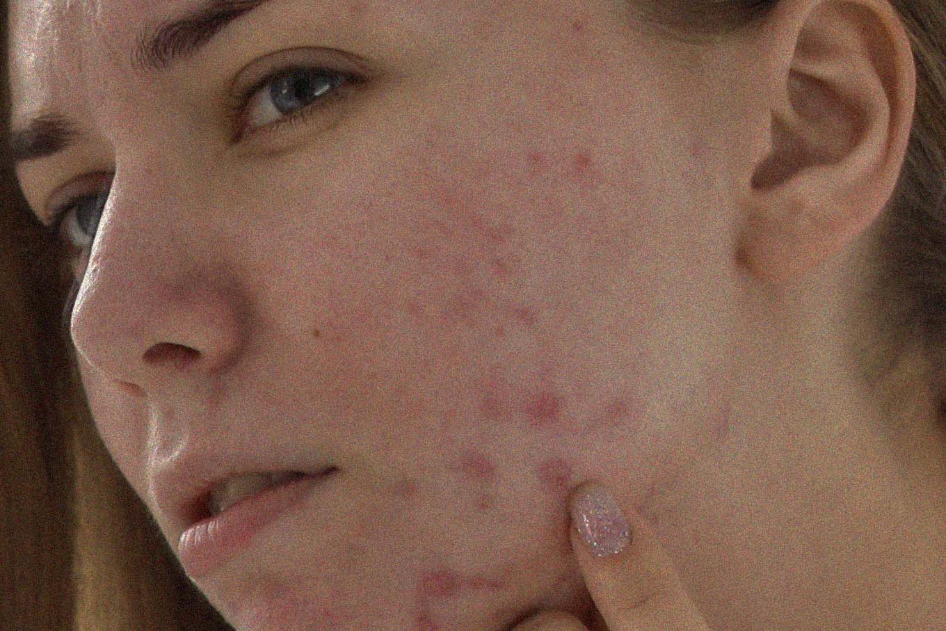 My Favourite Acne Treatments - Adapalene (Differin)