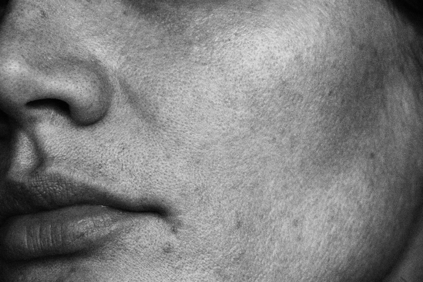 Uneven Skin Texture