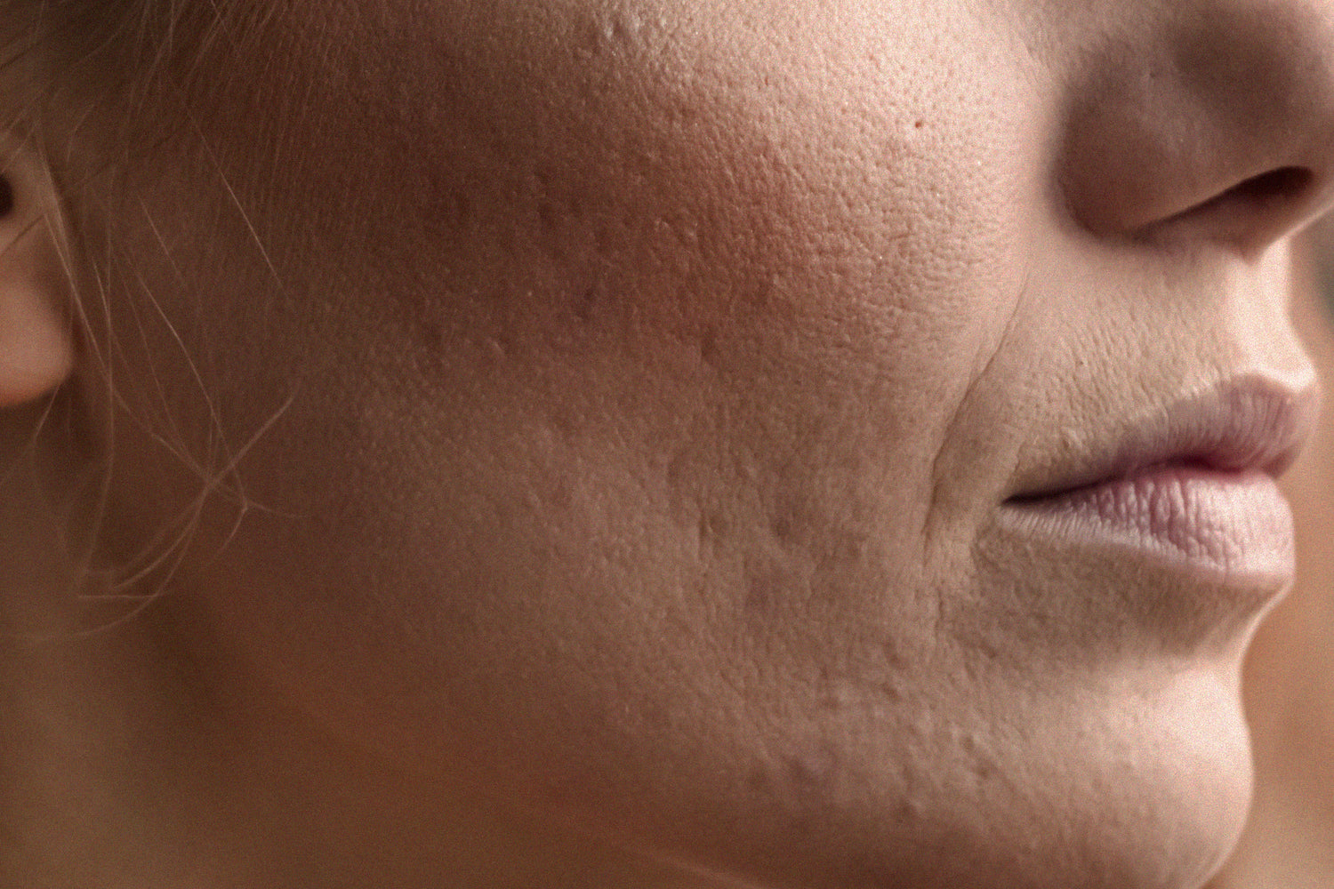 Dr Rakesh Answers Your Questions on Acne Scarring