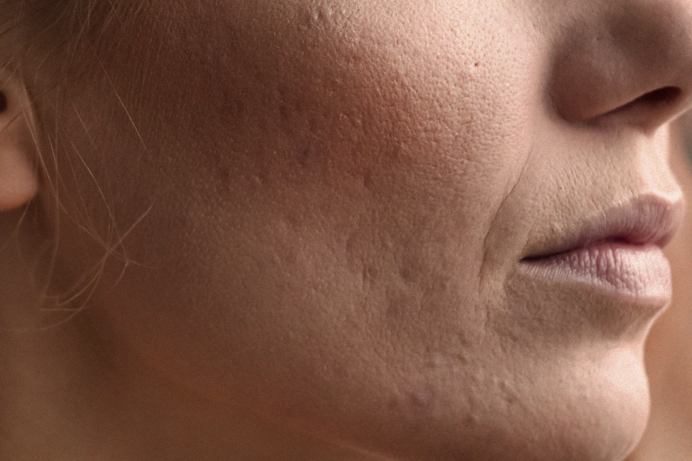 Dr Rakesh Answers Your Questions on Acne Scarring